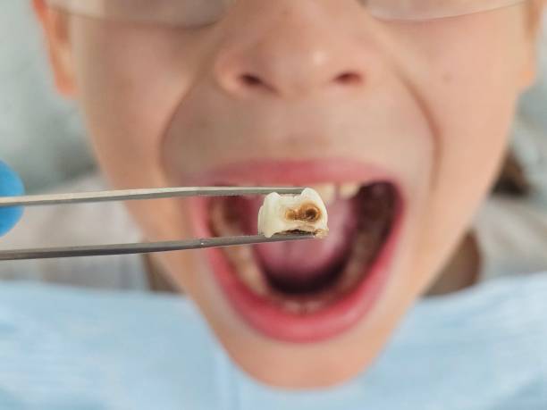 Best Broken or Chipped Tooth Repair in Lake Forest, CA